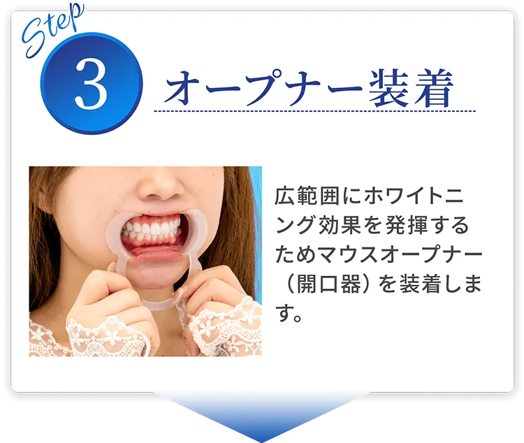 step03 オープナー装着 広範囲にホワイトニング効果を発揮するためマウスオープナー（開口器）を装着します。