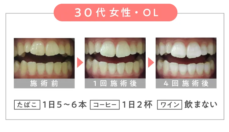 ＼ ３０代 女性・OL ／【 たばこ 】１日5~6本【 コーヒー 】１日２杯 【 ワイン 】飲まない